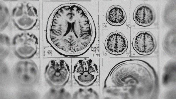 Découvrez si la mélatonine a un effet neuroprotecteur